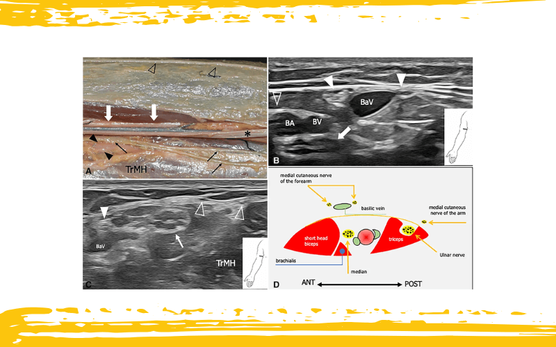 3. Nervio intercostobraquial y nervio cutaneo medial del brazo.png